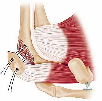 العلاج التحفظي وتثبيت الكتف