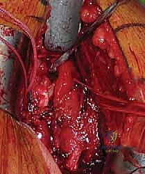 كسور الجزء الداني من عظم العضد: دليل شامل للعلاج والتعافي مع الأستاذ الدكتور محمد هطيف