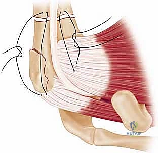 صورة توضيحية لـ كسور الجزء الداني من عظم العضد: دليل شامل للعلاج والتعافي مع الأستاذ الدكتور محمد هطيف