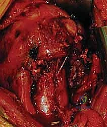 صورة توضيحية لـ كسور الجزء الداني من عظم العضد: دليل شامل للعلاج والتعافي مع الأستاذ الدكتور محمد هطيف