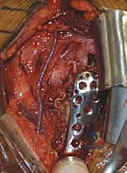 الأعراض السريرية لكسور العضد العلوية