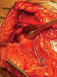 تصنيف نير لكسور الجزء الداني من عظم العضد