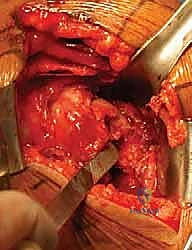 صورة توضيحية لـ كسور الجزء الداني من عظم العضد: دليل شامل للعلاج والتعافي مع الأستاذ الدكتور محمد هطيف