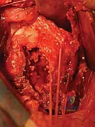 صورة توضيحية لـ كسور الجزء الداني من عظم العضد: دليل شامل للعلاج والتعافي مع الأستاذ الدكتور محمد هطيف