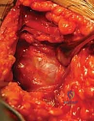 صورة طبية: كسور الجزء الداني من عظم العضد: دليل شامل للعلاج والتعافي مع الأستاذ الدكتور محمد هطيف