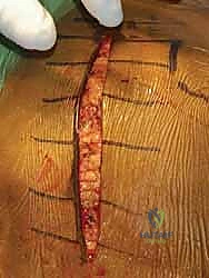 تأثير هشاشة العظام على كسور الكتف