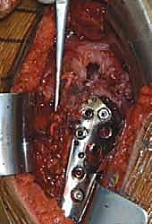 Illustration of fixation of proximal - Dr. Mohammed Hutaif