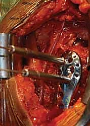 صورة طبية: كسور الجزء الداني من عظم العضد: دليل شامل للعلاج والتعافي مع الأستاذ الدكتور محمد هطيف