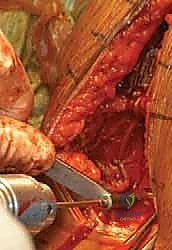 صورة توضيحية لـ كسور الجزء الداني من عظم العضد: دليل شامل للعلاج والتعافي مع الأستاذ الدكتور محمد هطيف