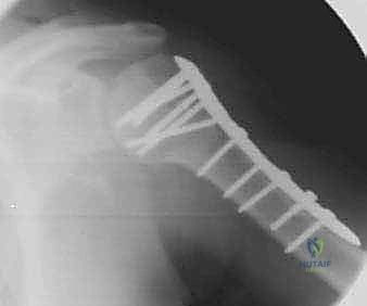 صورة توضيحية لـ كسور الجزء الداني من عظم العضد: دليل شامل للعلاج والتعافي مع الأستاذ الدكتور محمد هطيف
