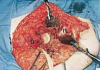 Intraoperative Surgical Step