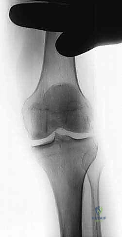 صورة توضيحية لـ استبدال مفصل الركبة الجزئي (UKA): دليل شامل لمرضى خشونة الركبة الداخلية مع الأستاذ الدكتور محمد هطيف