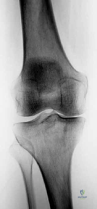 أهمية الأربطة الصليبية في استقرار مفصل الركبة