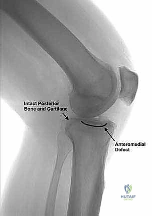 تآكل الغضروف في الجزء الداخلي لمفصل الركبة