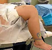 تقييم الأعراض السريرية لخشونة الركبة