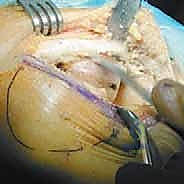 صورة طبية: استبدال مفصل الركبة الجزئي (UKA): دليل شامل لمرضى خشونة الركبة الداخلية مع الأستاذ الدكتور محمد هطيف