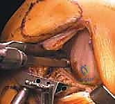 صورة طبية: استبدال مفصل الركبة الجزئي (UKA): دليل شامل لمرضى خشونة الركبة الداخلية مع الأستاذ الدكتور محمد هطيف