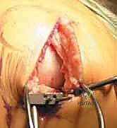 صورة طبية: استبدال مفصل الركبة الجزئي (UKA): دليل شامل لمرضى خشونة الركبة الداخلية مع الأستاذ الدكتور محمد هطيف