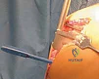 صورة توضيحية لـ استبدال مفصل الركبة الجزئي (UKA): دليل شامل لمرضى خشونة الركبة الداخلية مع الأستاذ الدكتور محمد هطيف