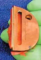 الخيارات العلاجية المتدرجة لخشونة الركبة