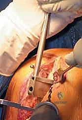 صورة طبية: استبدال مفصل الركبة الجزئي (UKA): دليل شامل لمرضى خشونة الركبة الداخلية مع الأستاذ الدكتور محمد هطيف