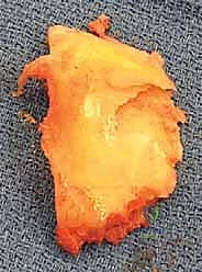 بيوميكانيكا الركبة والمحاذاة الصحيحة أثناء الجراحة