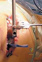 صورة طبية: استبدال مفصل الركبة الجزئي (UKA): دليل شامل لمرضى خشونة الركبة الداخلية مع الأستاذ الدكتور محمد هطيف