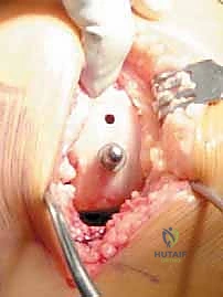 صورة طبية: استبدال مفصل الركبة الجزئي (UKA): دليل شامل لمرضى خشونة الركبة الداخلية مع الأستاذ الدكتور محمد هطيف