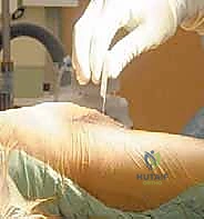 صورة طبية: استبدال مفصل الركبة الجزئي (UKA): دليل شامل لمرضى خشونة الركبة الداخلية مع الأستاذ الدكتور محمد هطيف