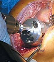 صورة طبية: استبدال مفصل الركبة الجزئي (UKA): دليل شامل لمرضى خشونة الركبة الداخلية مع الأستاذ الدكتور محمد هطيف