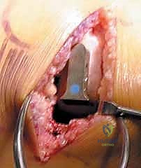 صورة توضيحية لـ استبدال مفصل الركبة الجزئي (UKA): دليل شامل لمرضى خشونة الركبة الداخلية مع الأستاذ الدكتور محمد هطيف