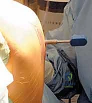 صورة توضيحية لـ استبدال مفصل الركبة الجزئي (UKA): دليل شامل لمرضى خشونة الركبة الداخلية مع الأستاذ الدكتور محمد هطيف