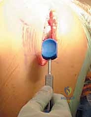 تأثير تقوس الساقين على زيادة الضغط في الركبة الداخلية