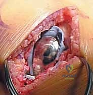 مقارنة بين استبدال الركبة الجزئي والكلي