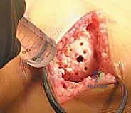 صورة توضيحية لـ استبدال مفصل الركبة الجزئي (UKA): دليل شامل لمرضى خشونة الركبة الداخلية مع الأستاذ الدكتور محمد هطيف