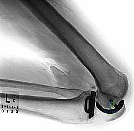 التقنيات الحديثة في جراحة استبدال مفصل الركبة الجزئي