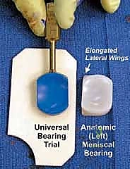 Illustration of unicondylar knee arthroplasty - Dr. Mohammed Hutaif
