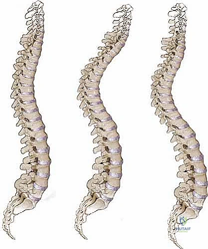 Mastering Adult Scoliosis: Intraoperative Techniques for Deformity Correction