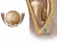 النتوءات العظمية في مفصل القدم