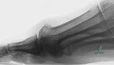 علاج تصلب إبهام القدم جراحياً: كل ما تحتاج معرفته عن استئصال النتوء العظمي الظهري مع الأستاذ الدكتور محمد هطيف