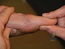 تشخيص حالة تصلب إبهام القدم