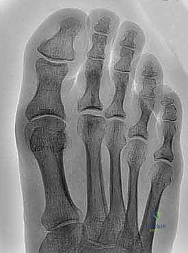 Dorsal Cheilectomy for Hallux Rigidus: An Intraoperative Masterclass
