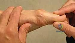 الأشعة السينية لتصلب إبهام القدم