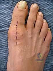 مراحل تطور الفصال العظمي في الإبهام