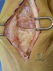 فحص حركة المفصل المشطي السلامي