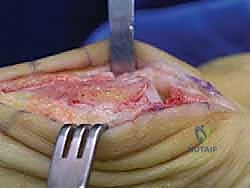 صورة توضيحية لـ علاج تصلب إبهام القدم جراحياً: كل ما تحتاج معرفته عن استئصال النتوء العظمي الظهري مع الأستاذ الدكتور محمد هطيف