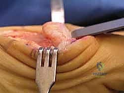 إزالة الزوائد العظمية بدقة عالية