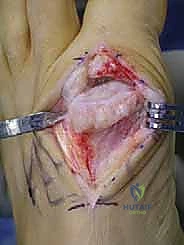 خطوات إجراء عملية استئصال النتوء الظهري