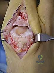 الحقن الموضعي في مفصل القدم