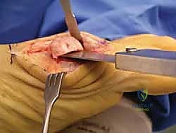 إغلاق الجرح بعد استئصال النتوء العظمي